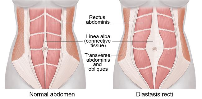 Diastasis Recti: The Belly Bulge That Won't Budge