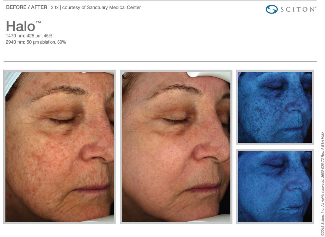 Laser Skin Resurfacing In Austin Round Rock Tx Synergy Plastic Surgery