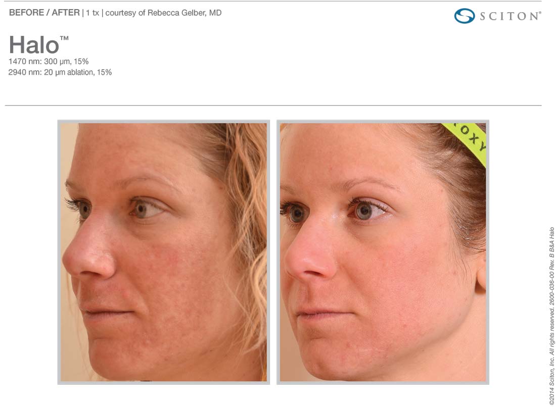 Laser Skin Resurfacing In Austin Round Rock Tx Synergy Plastic Surgery